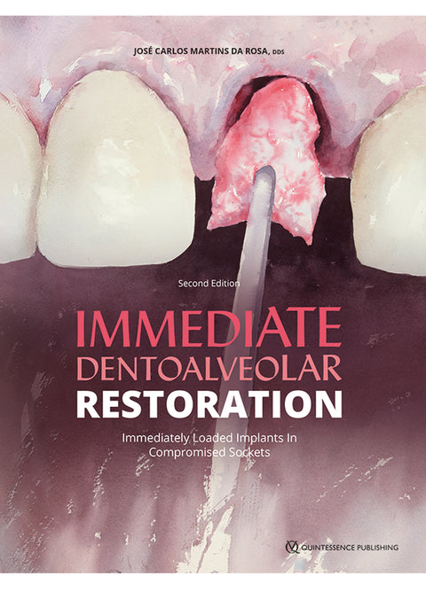 Immediate Dentoalveolar Restoration - Immediately Loaded Implants in Compromised Sockets